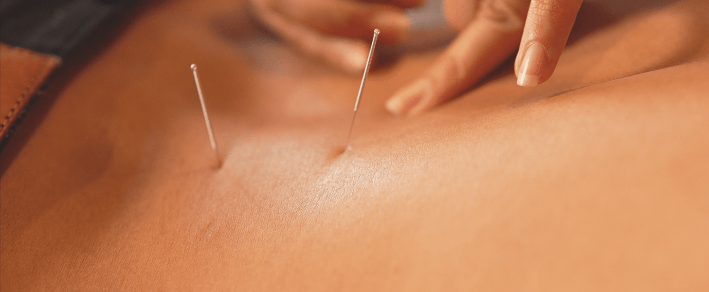 Unlocking Your Body's Natural Healing Power with Acupuncture