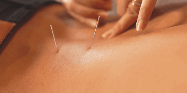 Unlocking Your Body's Natural Healing Power with Acupuncture