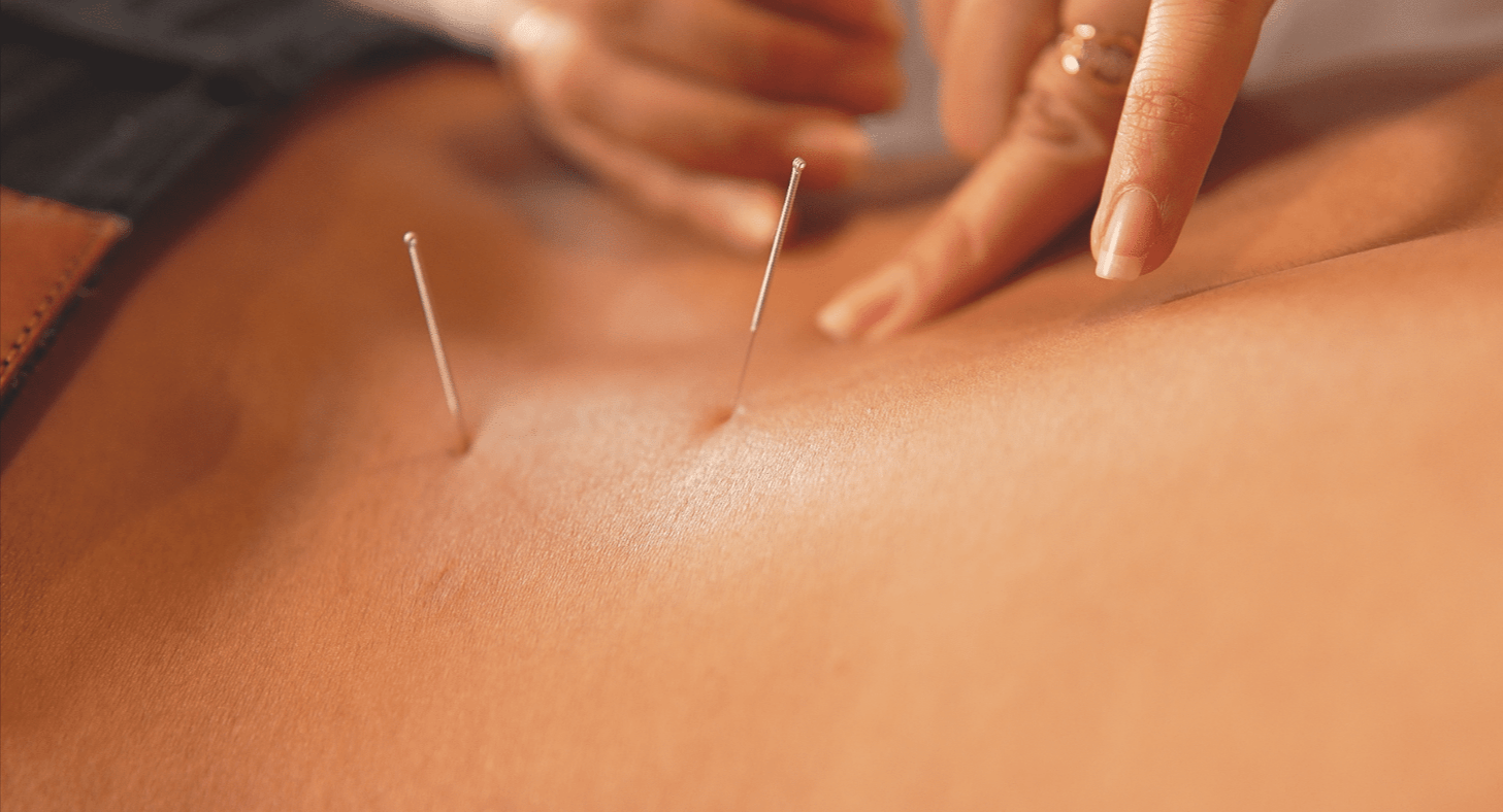Unlocking Your Body's Natural Healing Power with Acupuncture